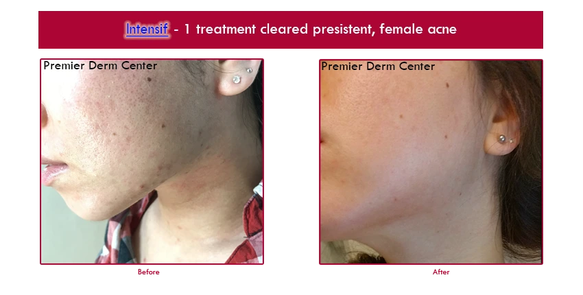 acne-radio-lumps ,Premier Derm Center PLLC | Houston, TX